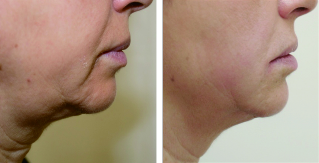 img_web_classys_com_uf_before_after_v1_002_72dpi.png