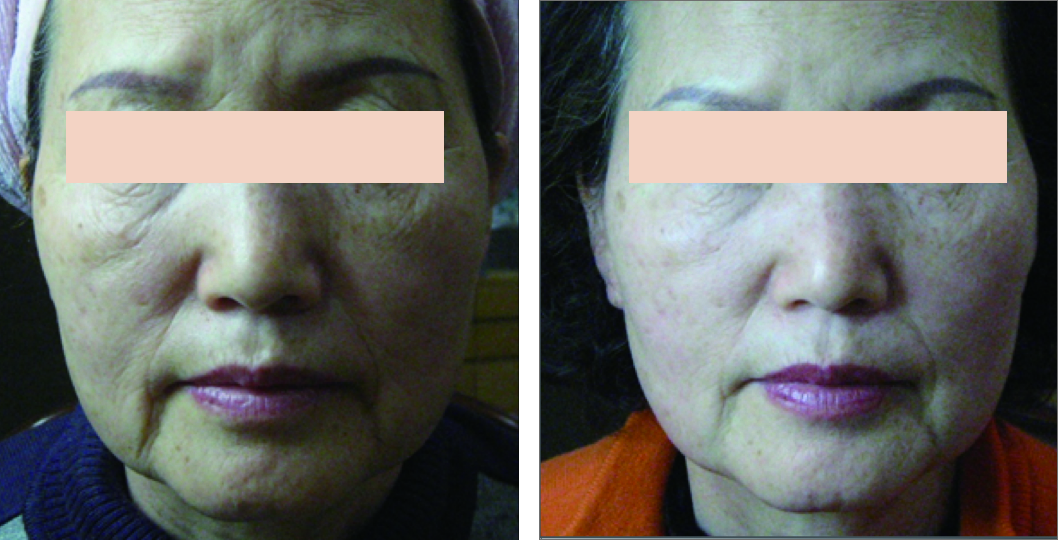 img_web_classys_com_uf_before_after_v1_003_72dpi.png