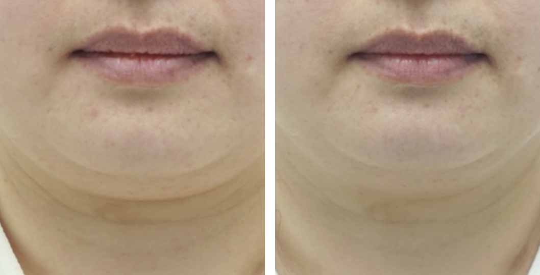 img_web_classys_en_clatuu_alpha_before_after_002_72dpi